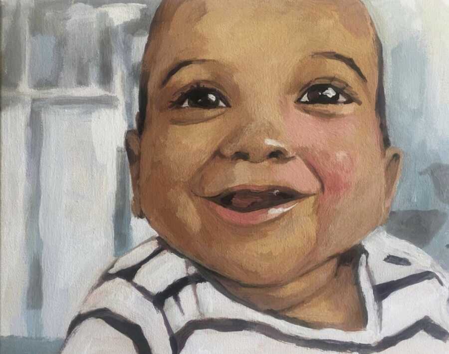 baby with port wine stain painting
