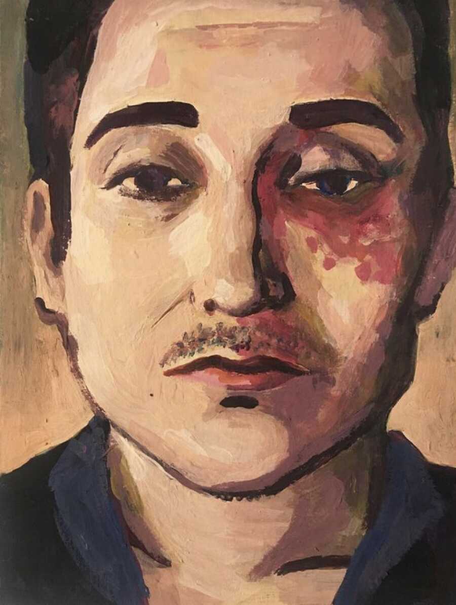 man with pws birth mark portrait