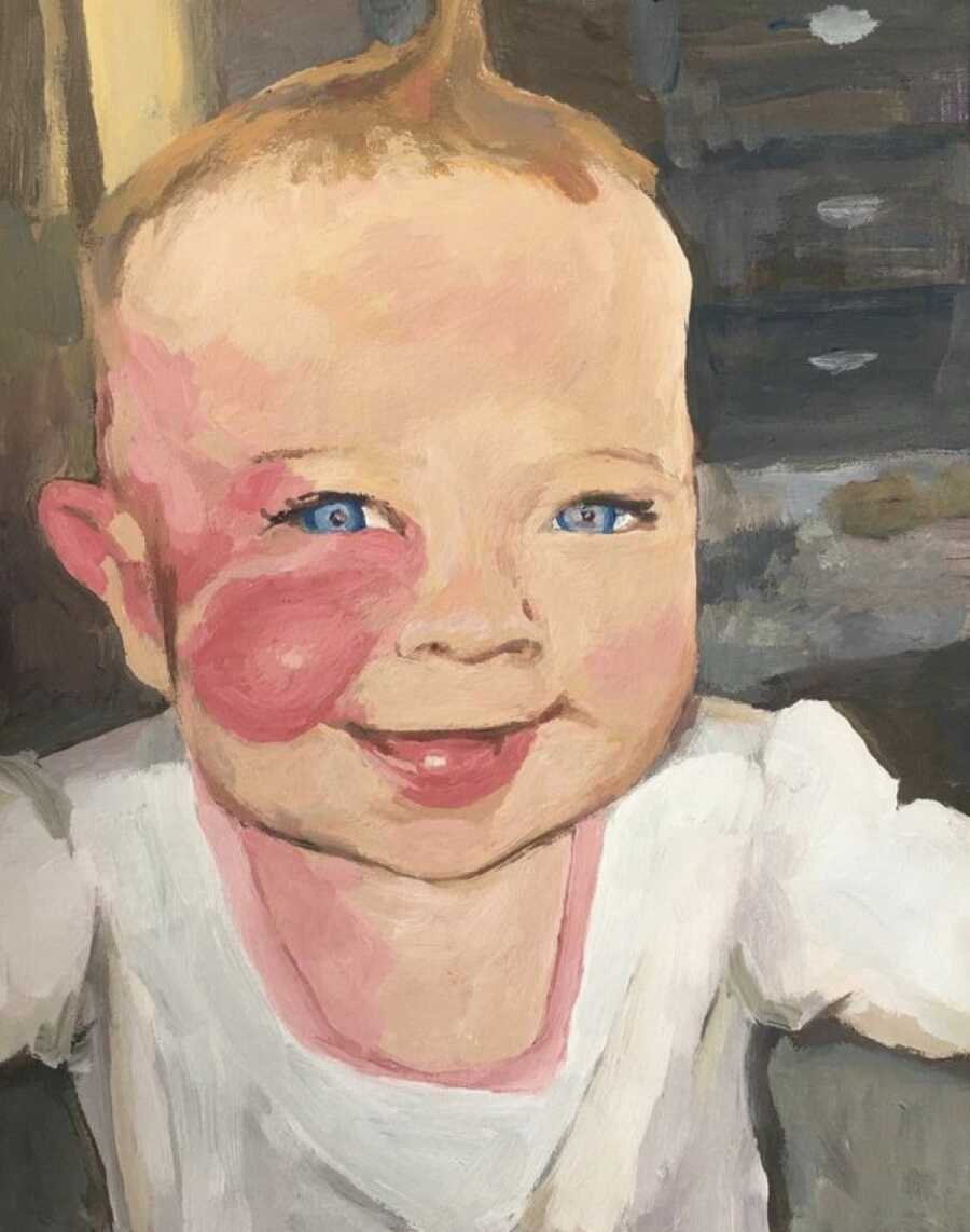 baby with pws birthmark painting