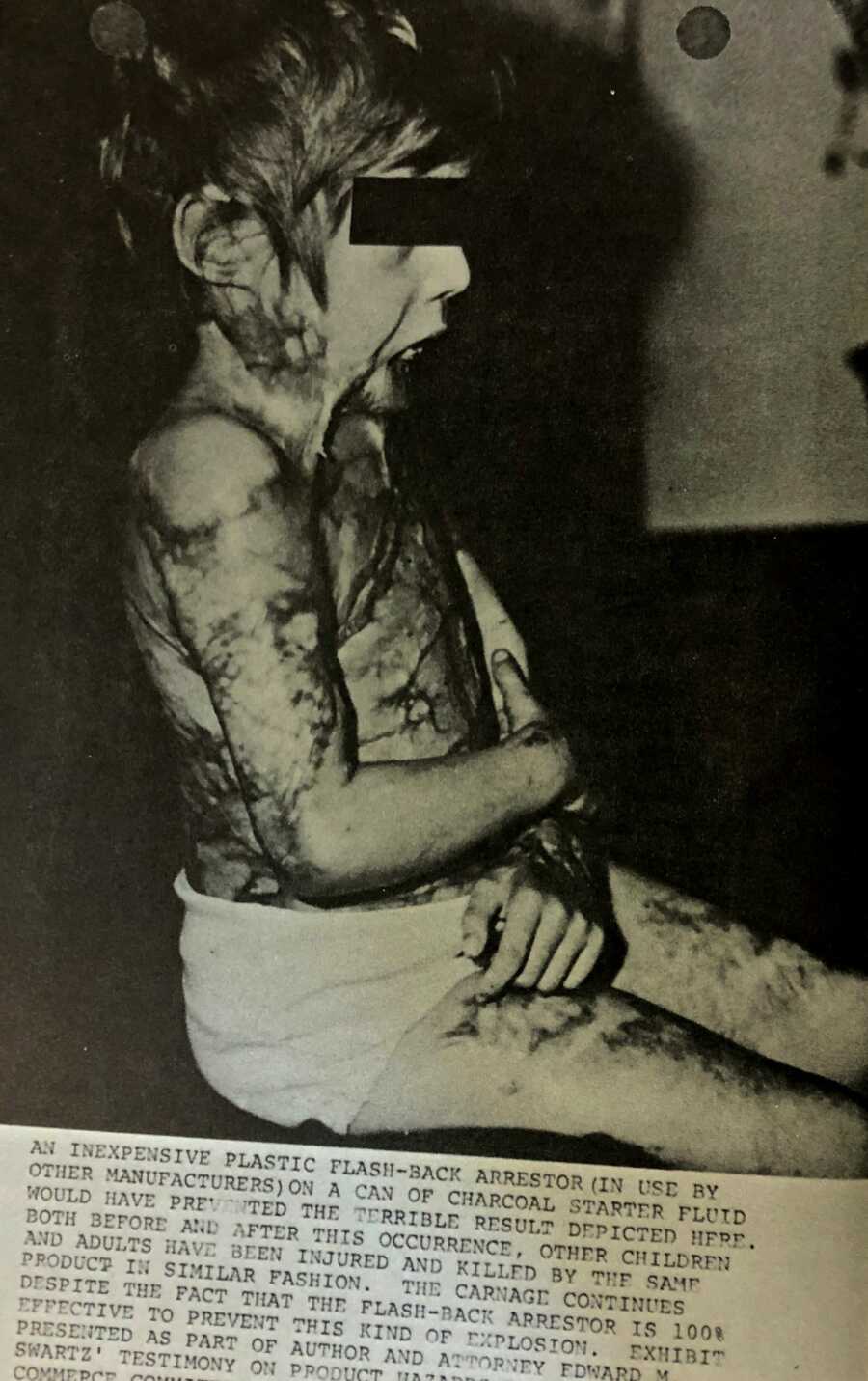 burn victim right after the fire