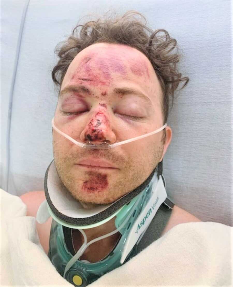 close up of the face of a man with severe injuries on a hospital bed