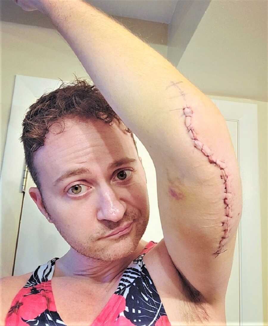 Selfie of man showing a long scar with stitches on the back of his left arm