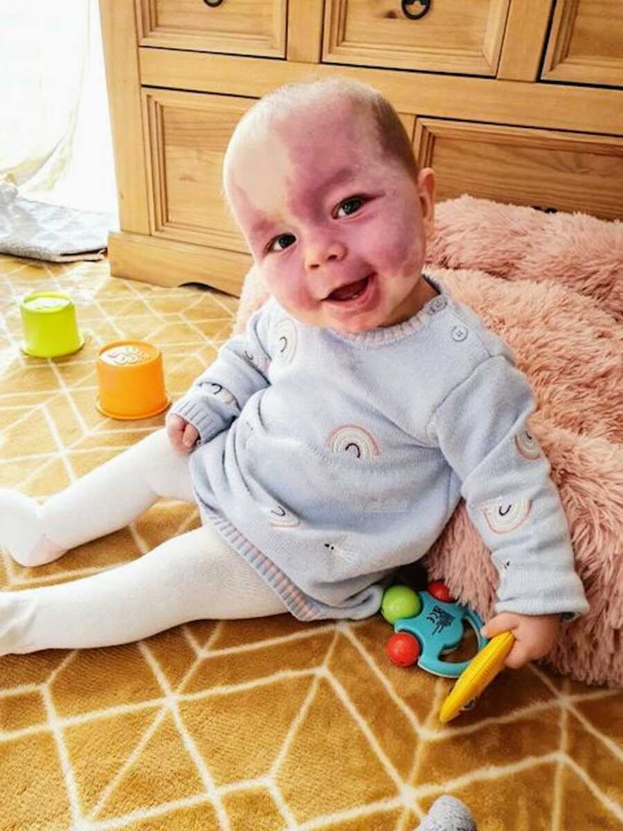 girl with sturge-weber syndrome plays with her toys