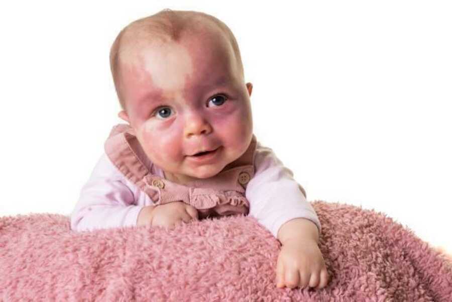 girl with sturge-weber syndrome smiling for photo