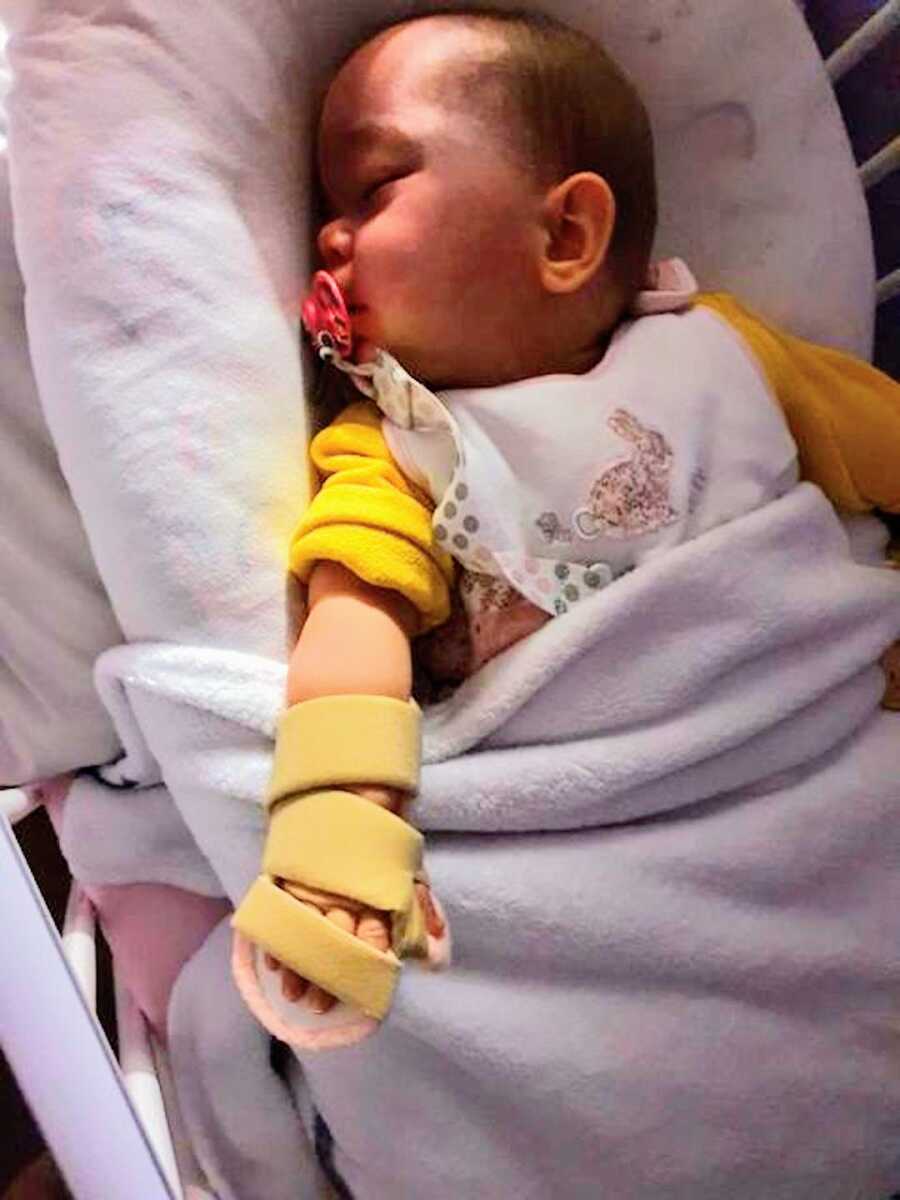 girl with sturge-weber syndrome wearing arm splint