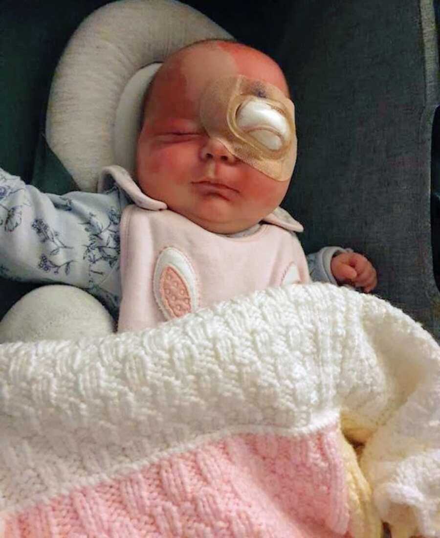 baby after her 2nd eye operation at 12 weeks