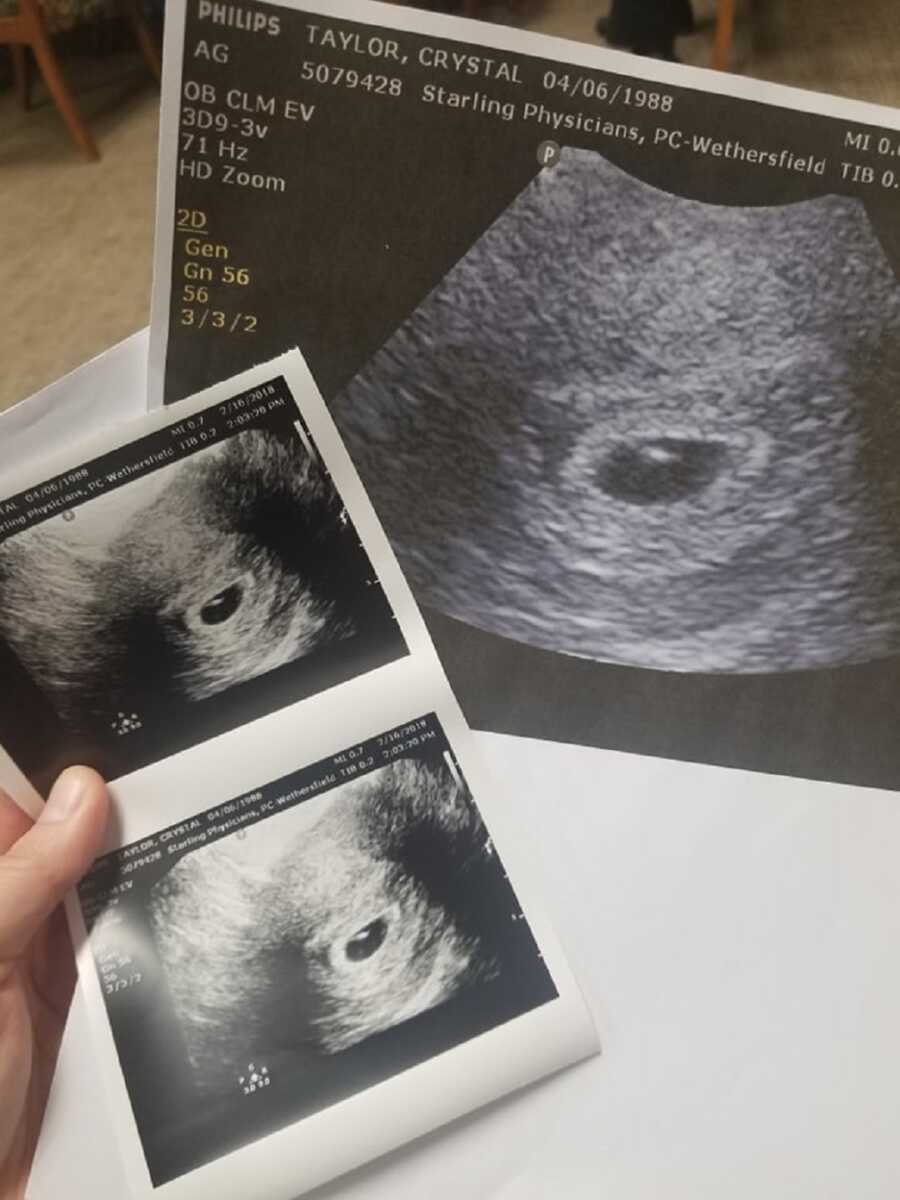 Woman who experienced pregnancy loss holds up sonogram picture.