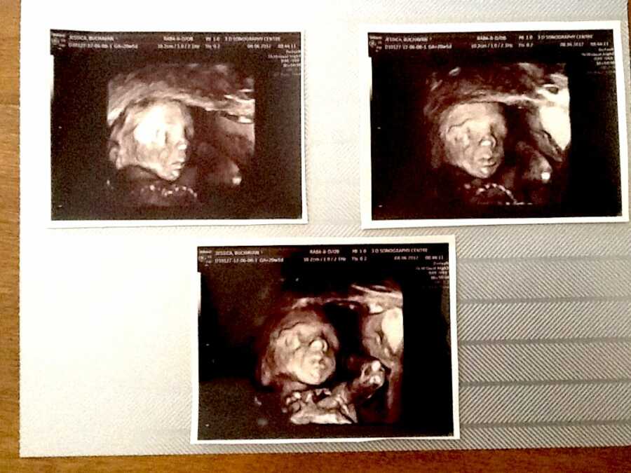 ultrasound photos showing the fac of the fetus