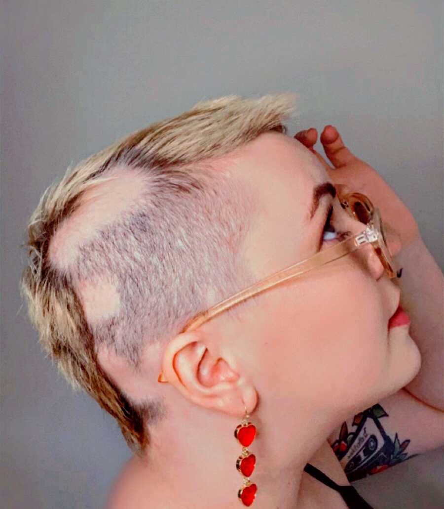 A woman with alopecia looks up while wearing heart earrings