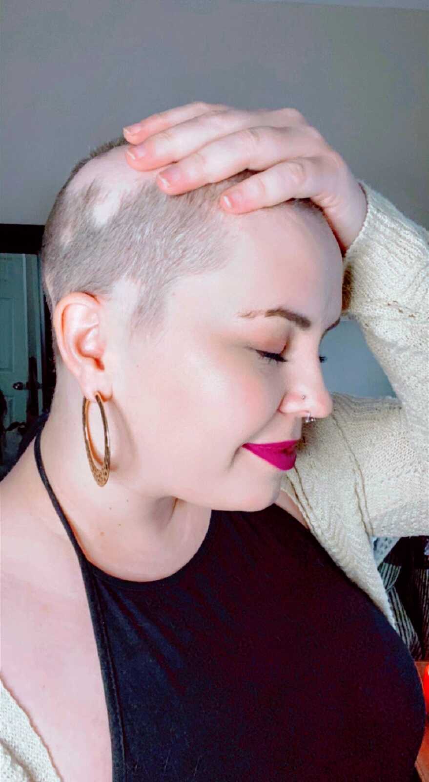 A woman experiencing hair loss holds her balding head