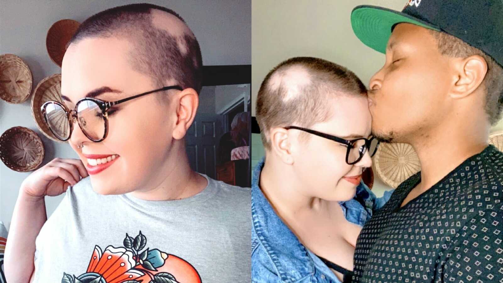 A young woman with alopecia and a man kisses his balding partner on the head