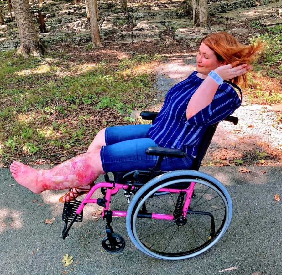 A woman with a leg affected by CRPS sits outside in her wheelchair