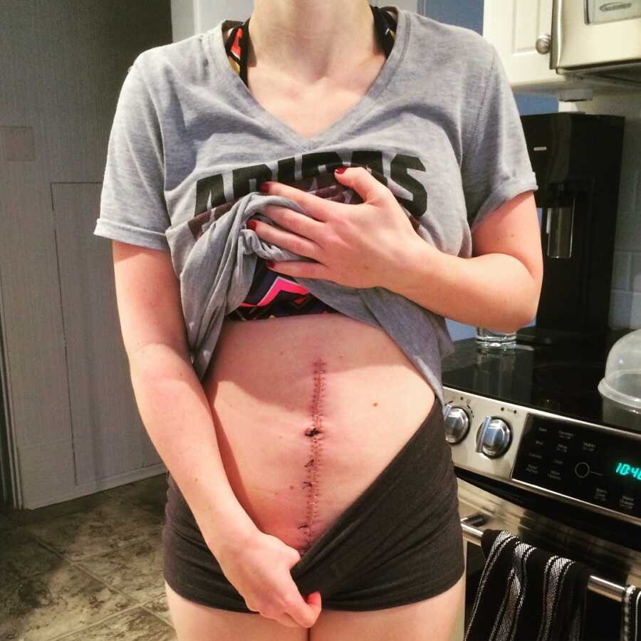 woman with staples in her stomach after surgery