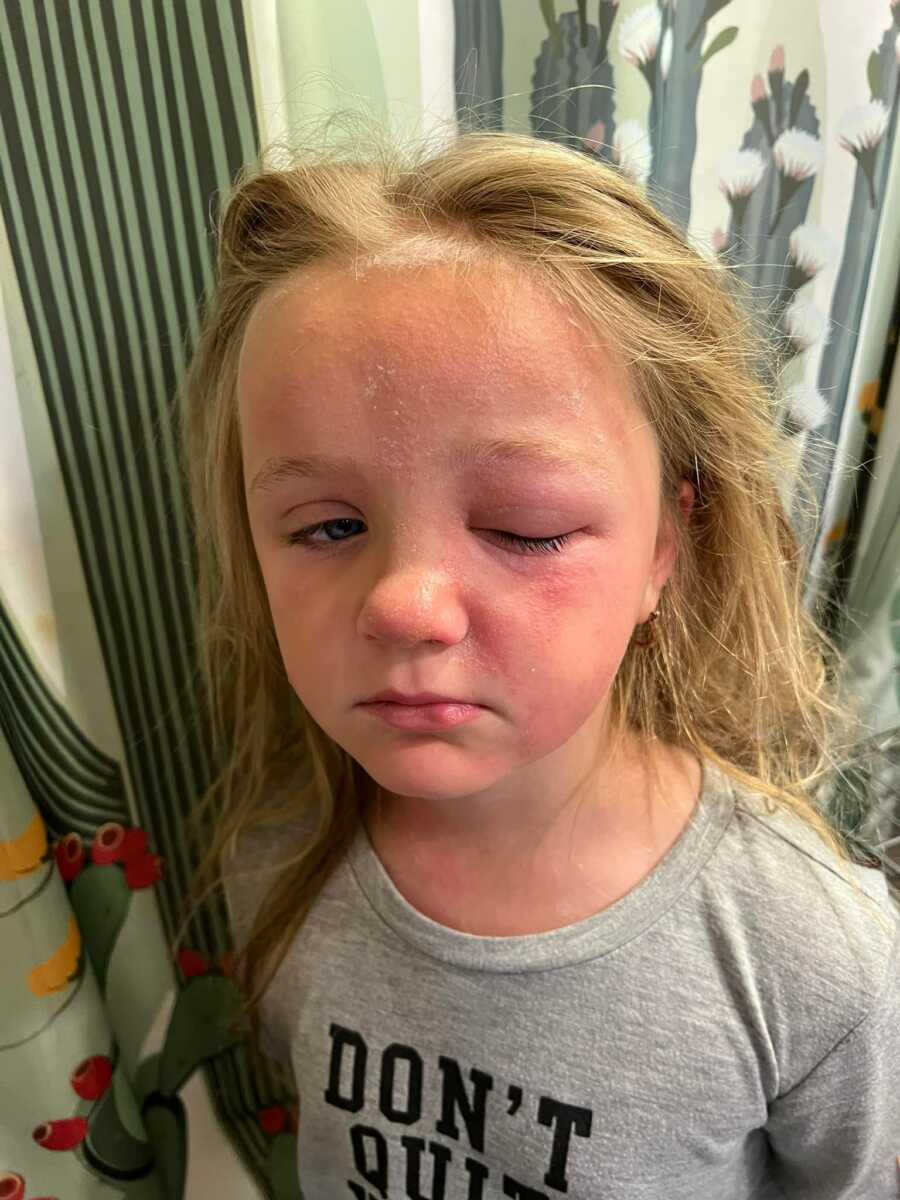 little girl suffering from poison hemlock