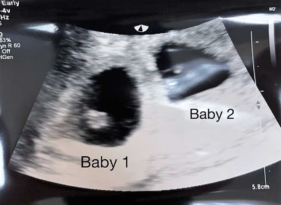 sonogram of twin girls in her mom's womb 