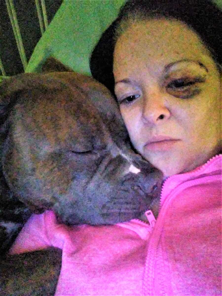 physically abused woman with a dark eye cuddling with a pit-bull dog