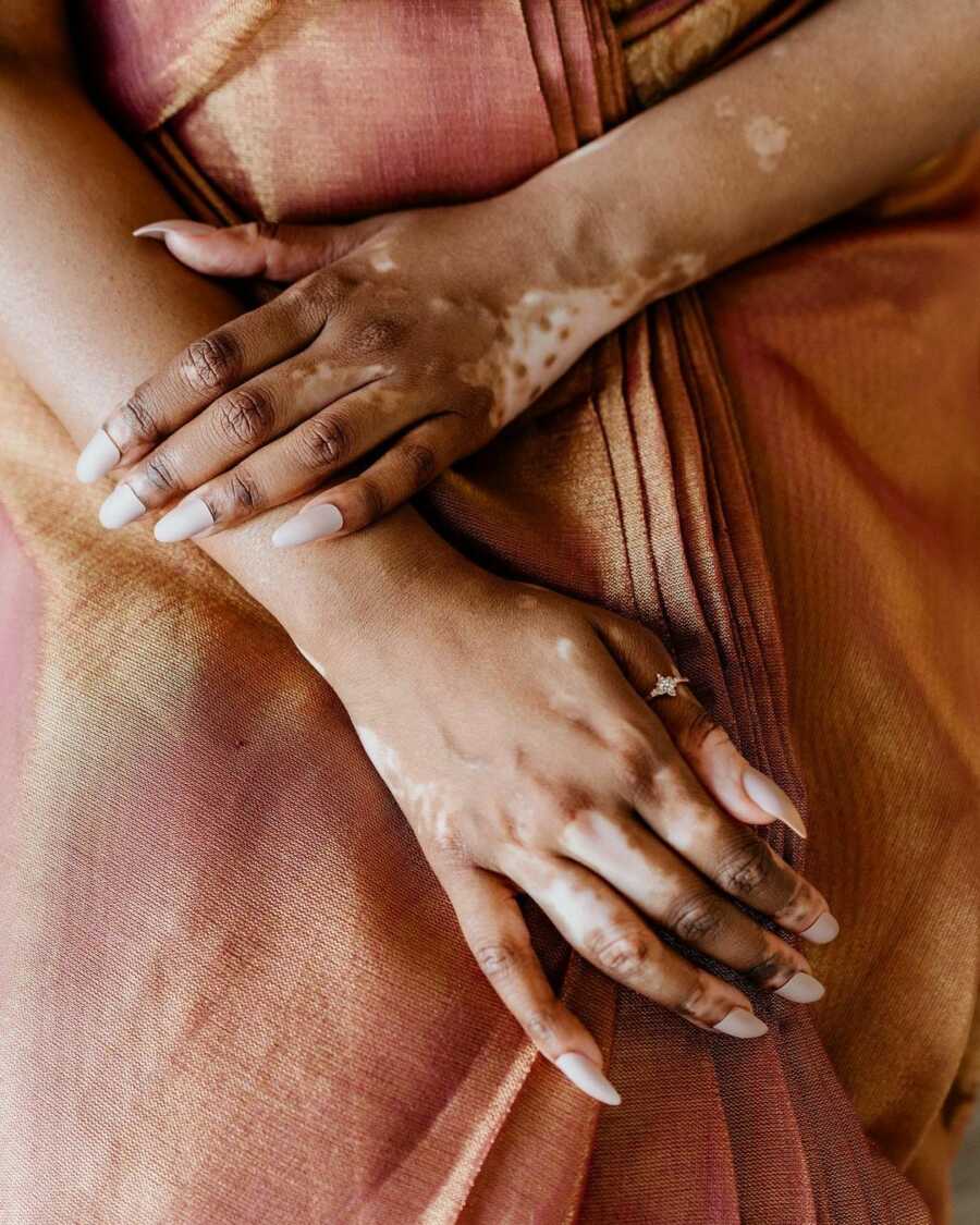 close up of a woman's hands with vitiligo