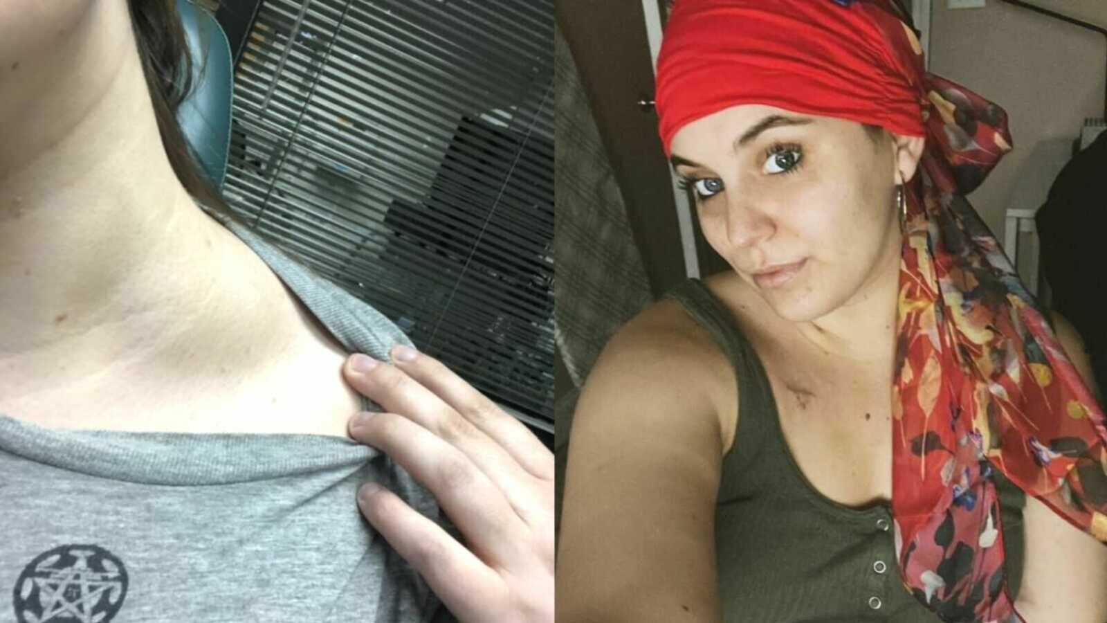 A woman displays her cancerous lump and a cancer survivor wearing a headscarf