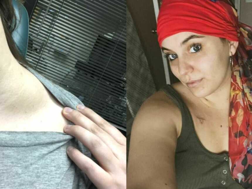 A woman displays her cancerous lump and a cancer survivor wearing a headscarf