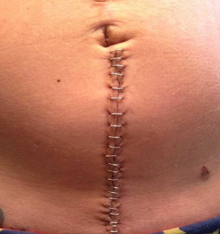 New mom takes picture of staples in her stomach after emergency hysterectomy.