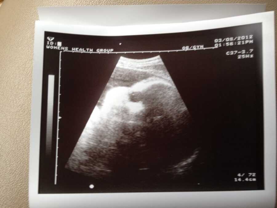 Ultrasound picture of baby girl.