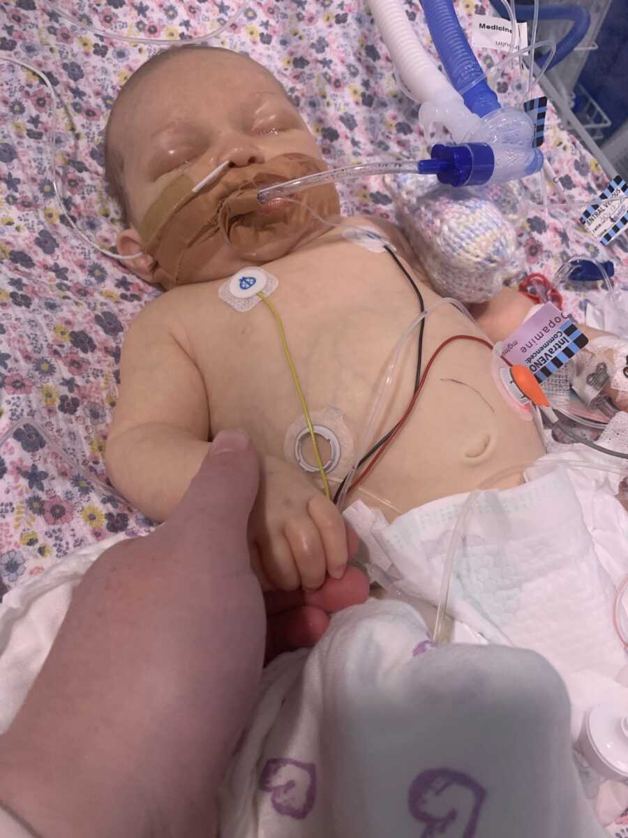 baby girl with a breathing tube