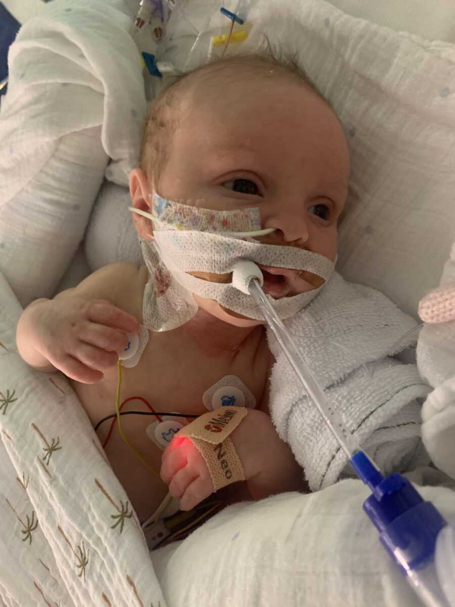 baby girl with a feeding tube