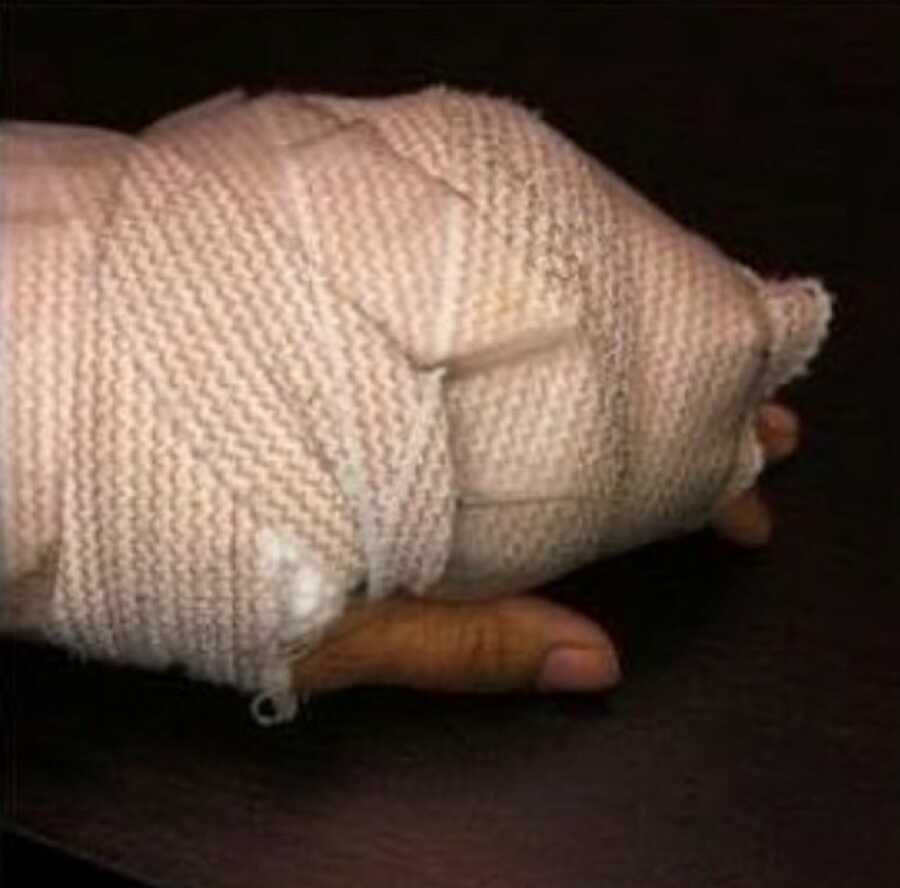 hand after surgery