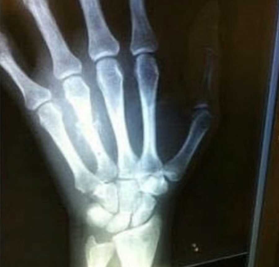 xray of hand