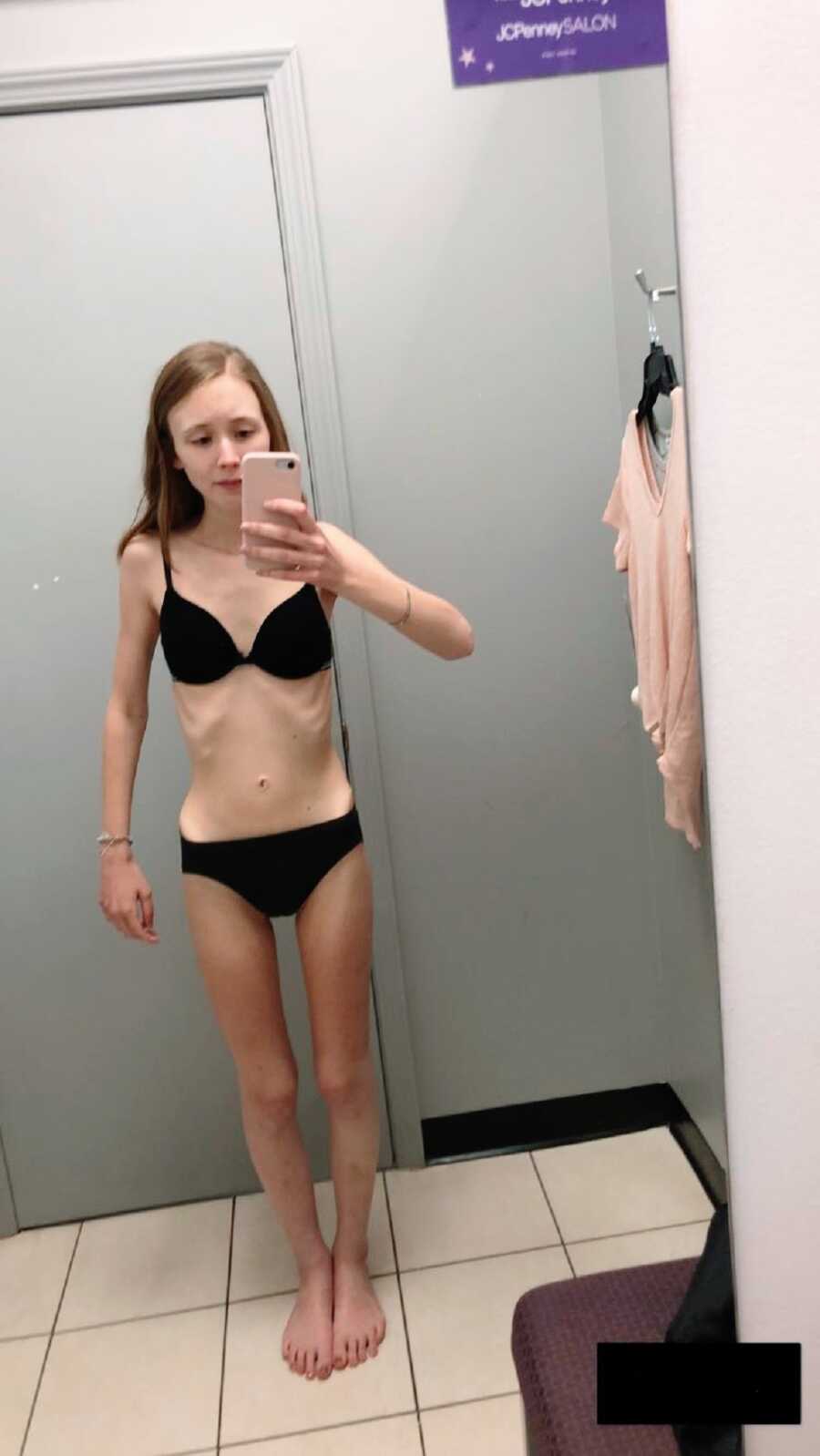 A young girl with an eating disorder wearing a bathing suit