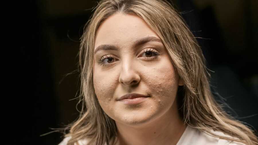 woman with acne smiling