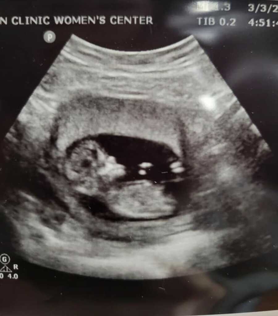 ultrasound of the baby