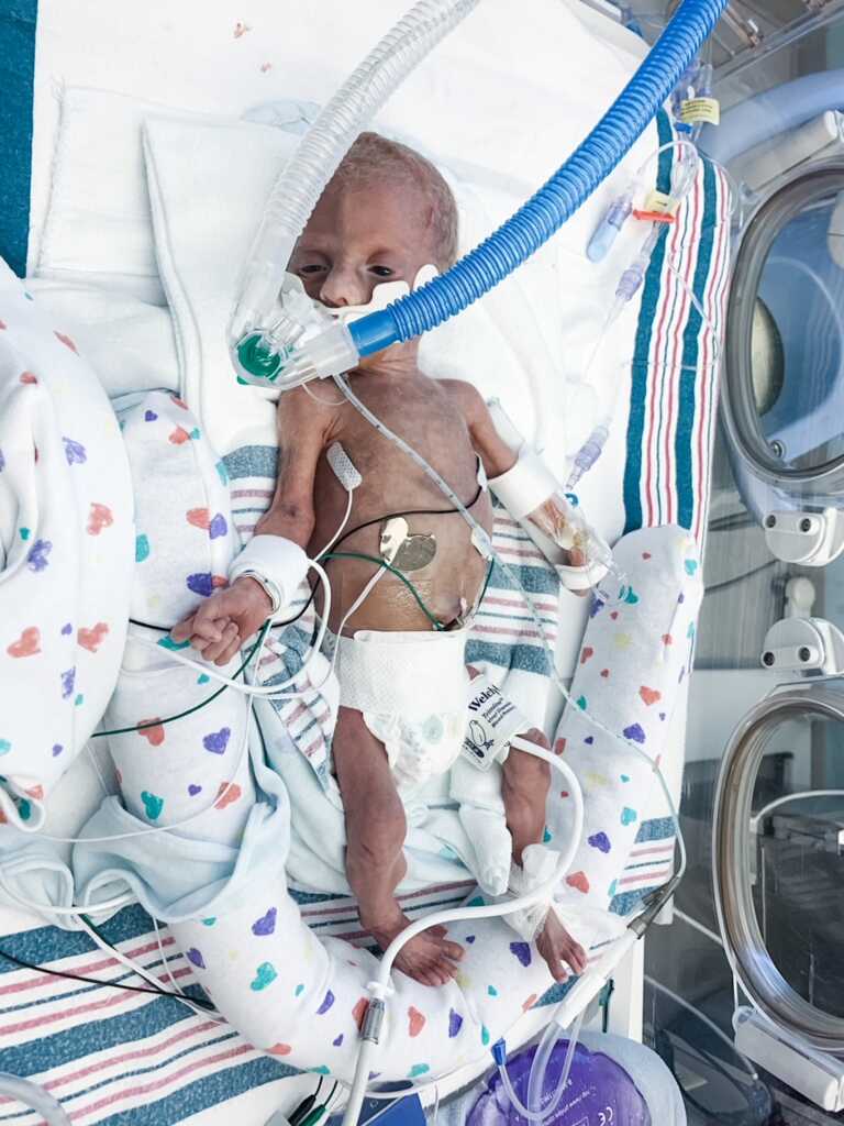 Boy Who Survived The Impossible After Nicu Catheter Punctured Vein Now