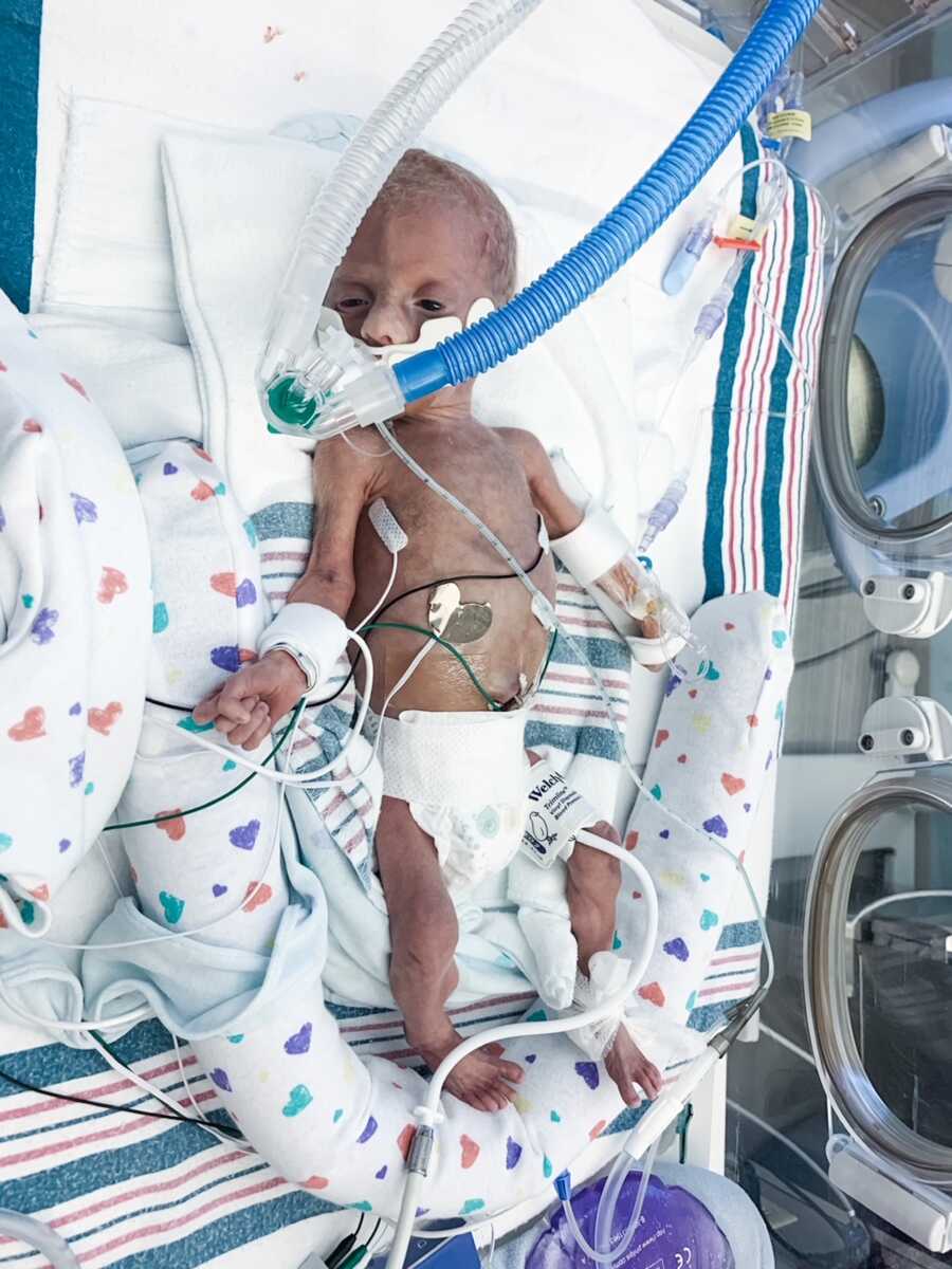 A premie baby is hooked up to oxygen and other cables in the NICU
