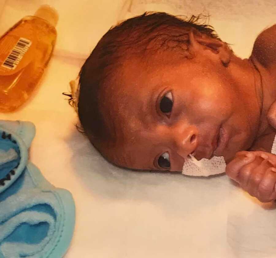 Baby with tube in her nose lies on her side on a baby blanket.