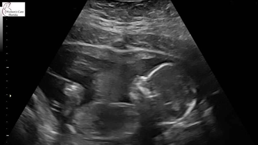 ultrasound photo