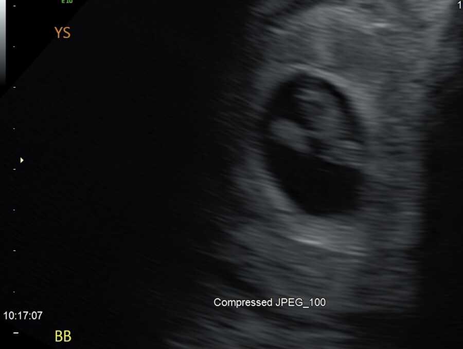 ultrasound photo