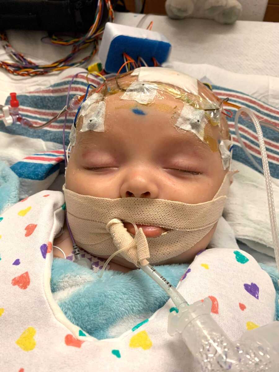 baby with shaken baby syndrome in hospital with breathing tube
