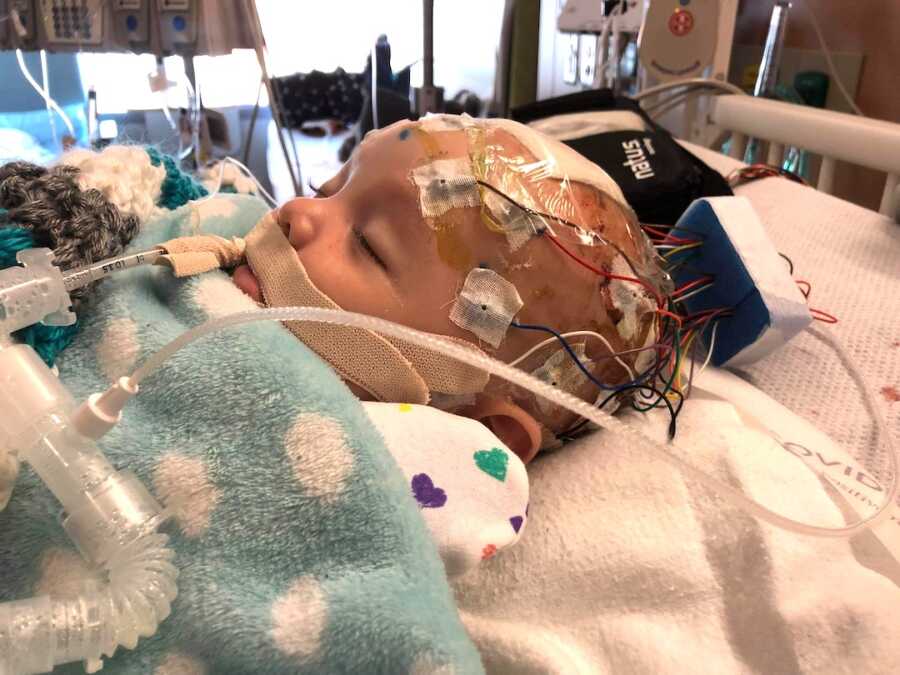 baby in hospital with shaken baby syndrome with monitors attached to head