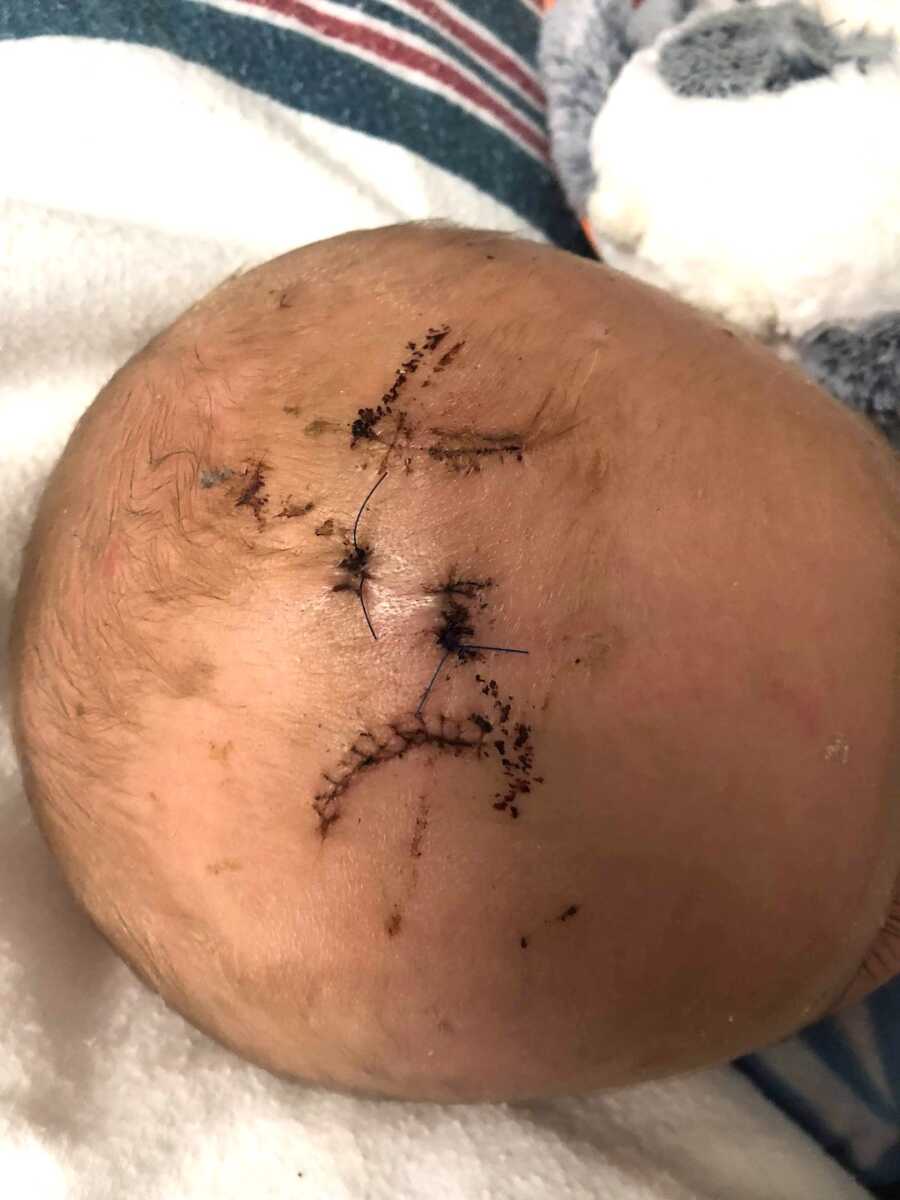 stitches on the top of an infants head