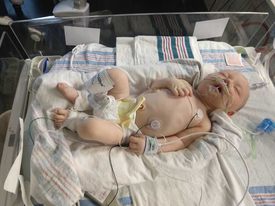 baby boy with Down Syndrome in the NICU