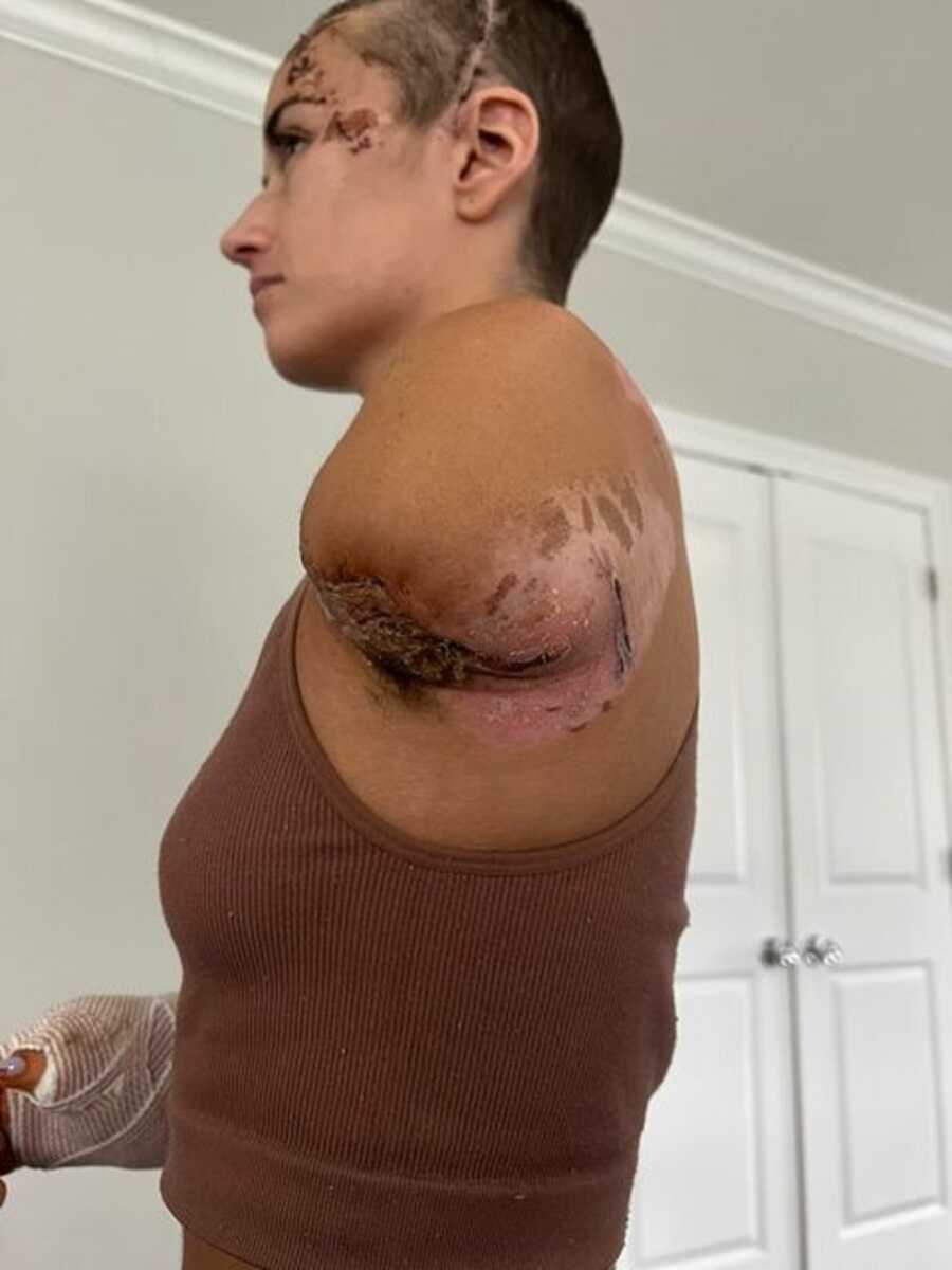 Car accident survivor takes a picture of her amputated arm and scars.