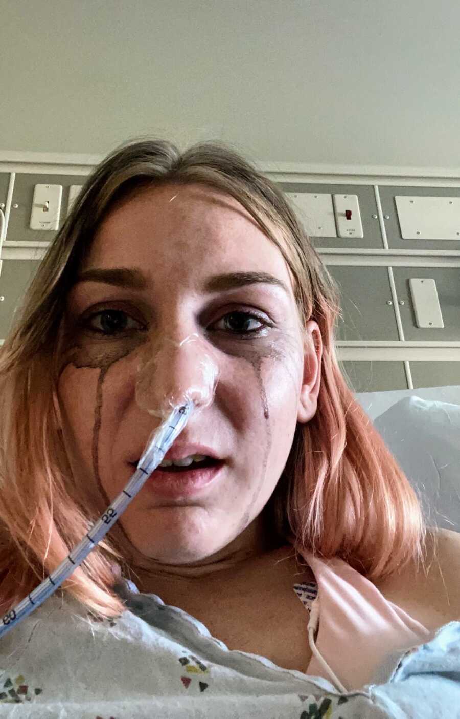 girl in eating disorder recovery with feeding tube