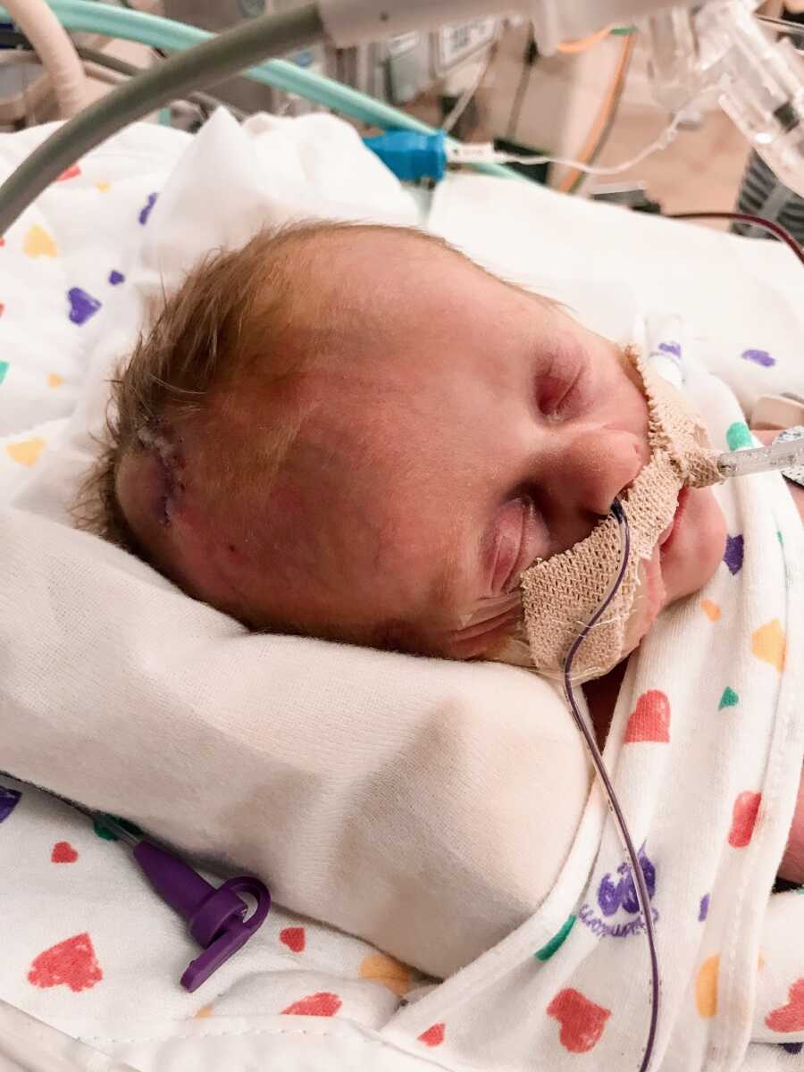 newborn baby girl with a breathing tube in her nose