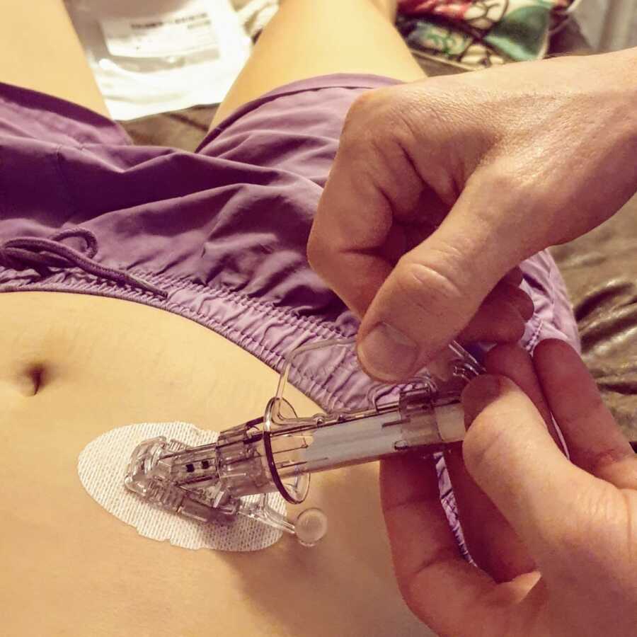 old CGM applicator being applied on stomach