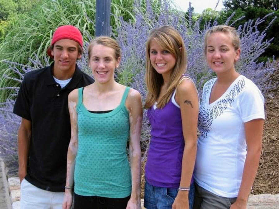teenager with vitiligo standing with her three siblings without vitiligo