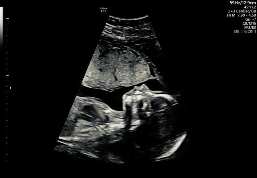 ultrasound of a baby girl