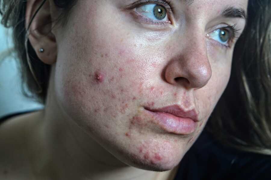 up close photo of woman with acne on face 