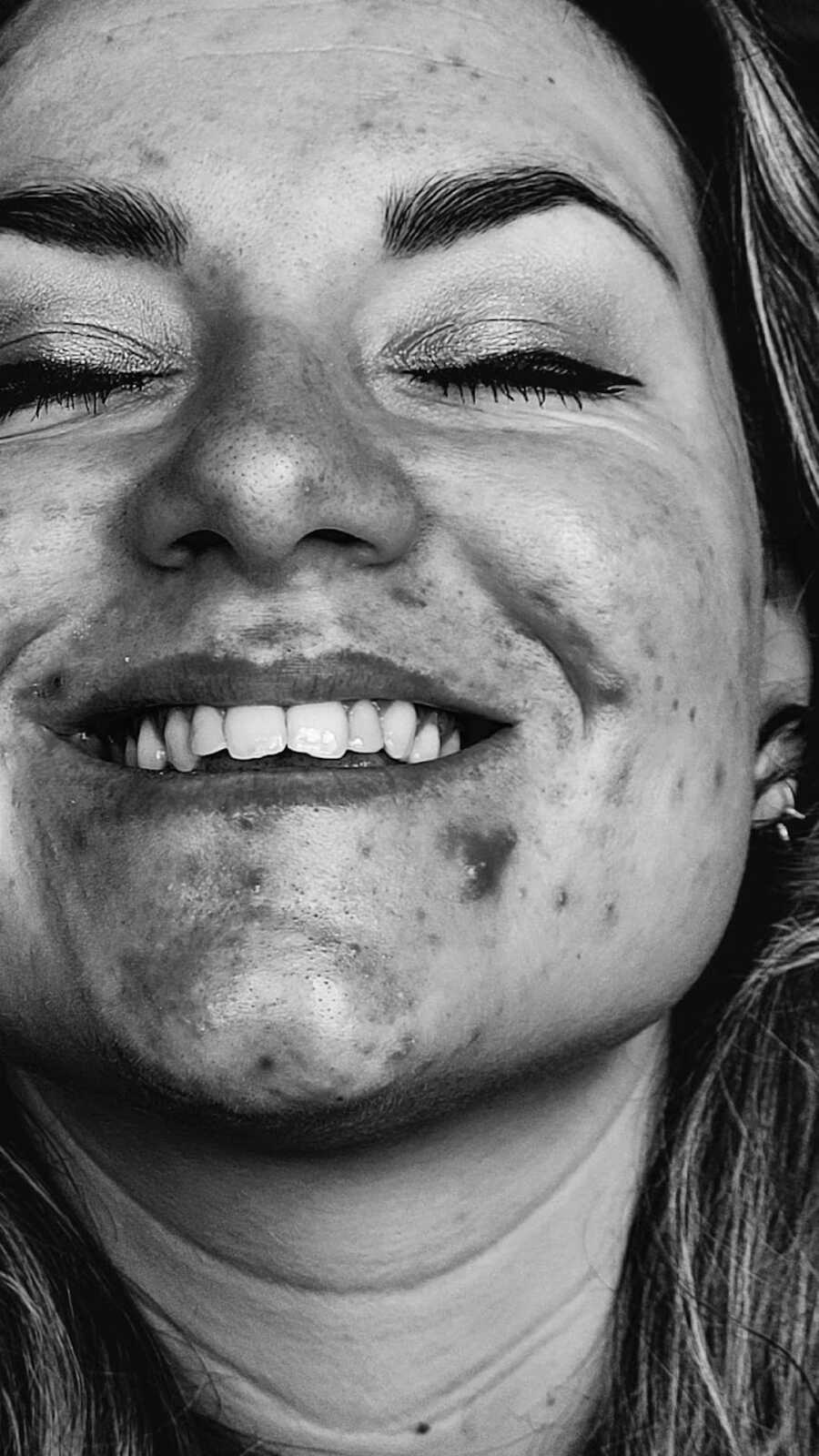 close up of woman smiling with acne marks in gray