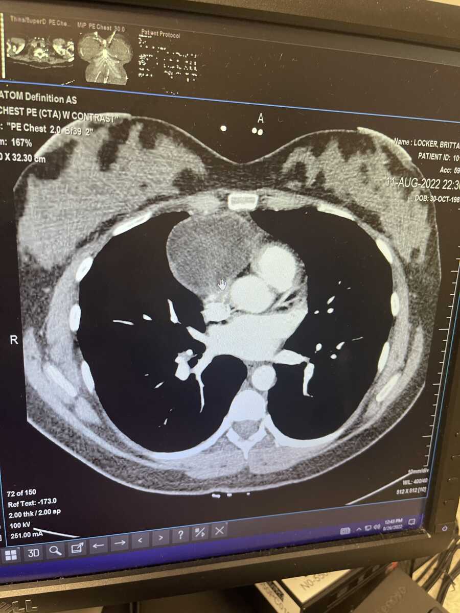 MRI of cancerous mass next to woman's heart